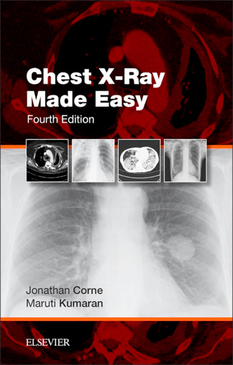 Chest Xray Made Easy