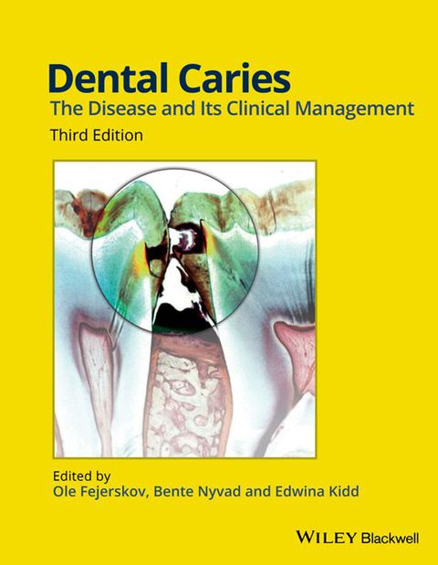 Dental Caries the Disease and Its Clinical Management