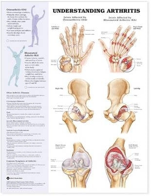 Understanding Arthritis Laminated Anatomical Chart