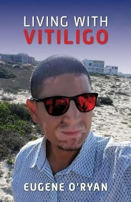 Living With Vitiligo